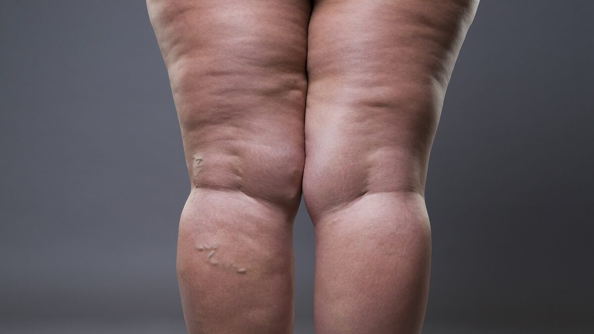 Possuem lipedema